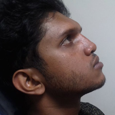  Rhinoplasty pauls-ent-care