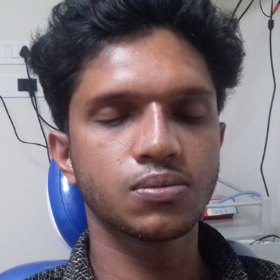  Rhinoplasty pauls-ent-care